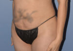 Tummy Tuck