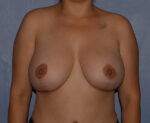 Breast Correction