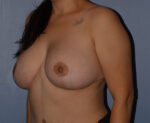 Breast Correction