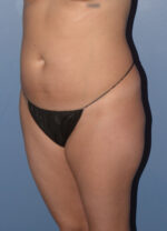 Liposuction