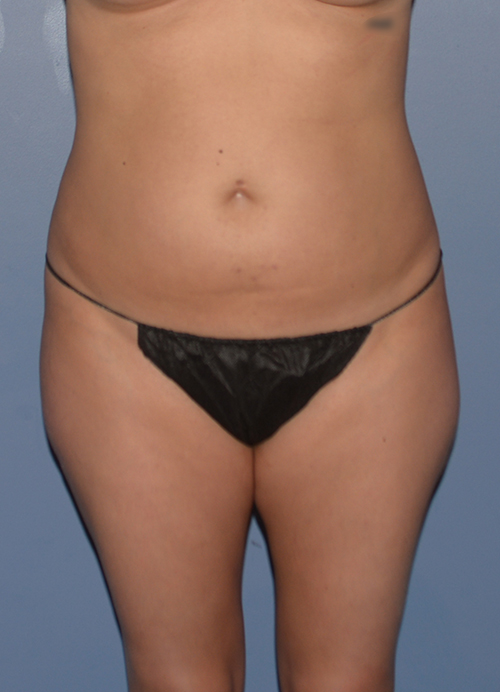 Liposuction