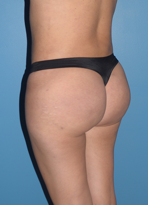 Liposuction