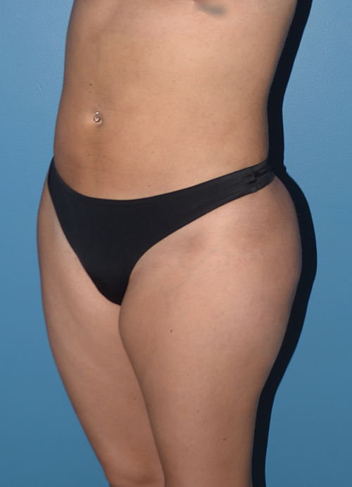 Liposuction