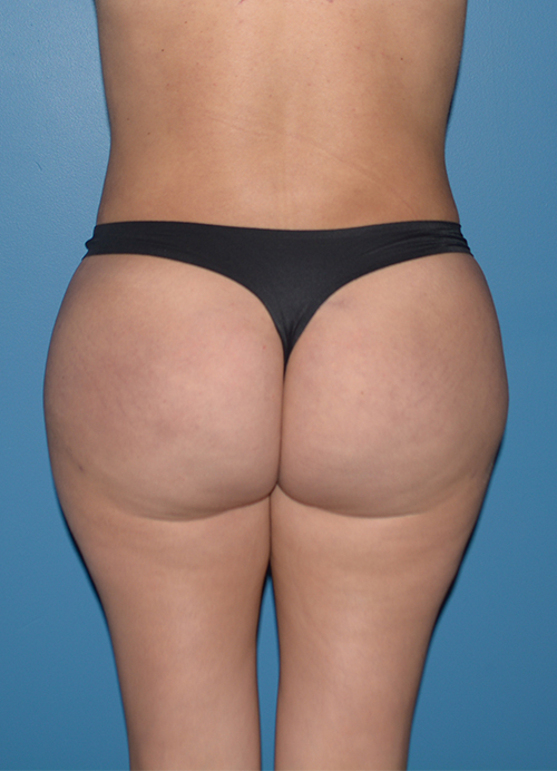 Liposuction