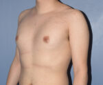 Male Breast Reduction