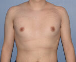 Male Breast Reduction