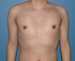 Male Breast Reduction