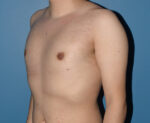 Male Breast Reduction