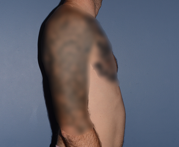 Pectoral Chest Implants