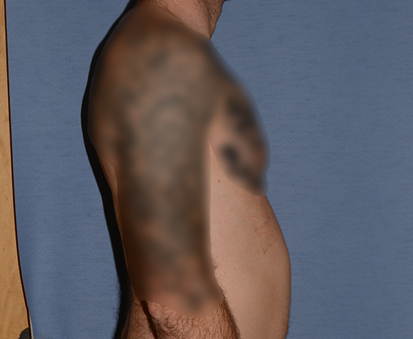 Pectoral Chest Implants