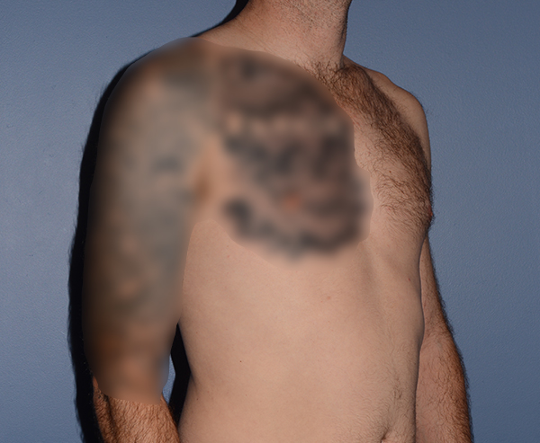 Pectoral Chest Implants