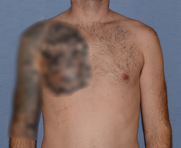 Pectoral Chest Implants