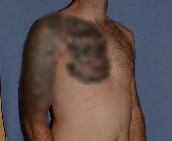 Pectoral Chest Implants