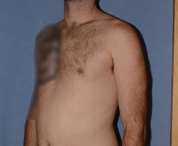 Pectoral Chest Implants