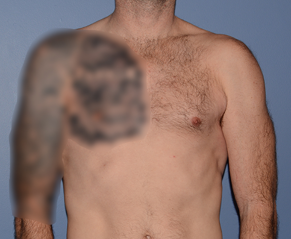 Pectoral Chest Implants