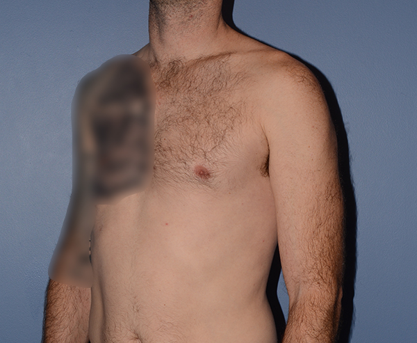 Pectoral Chest Implants