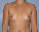 Breast Augmentation Implants