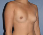 Breast Augmentation Implants