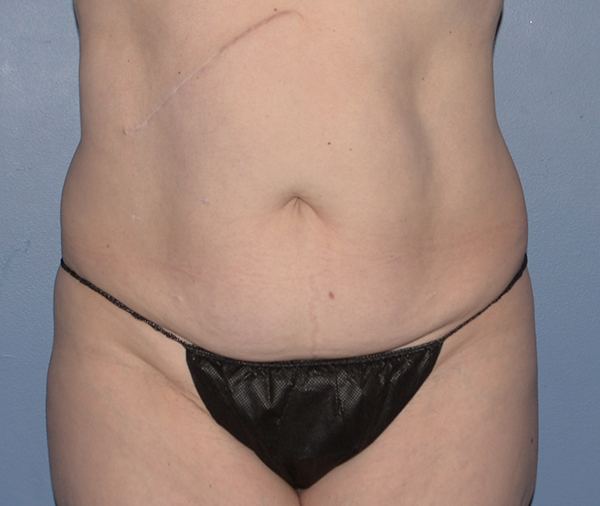 Tummy Tuck