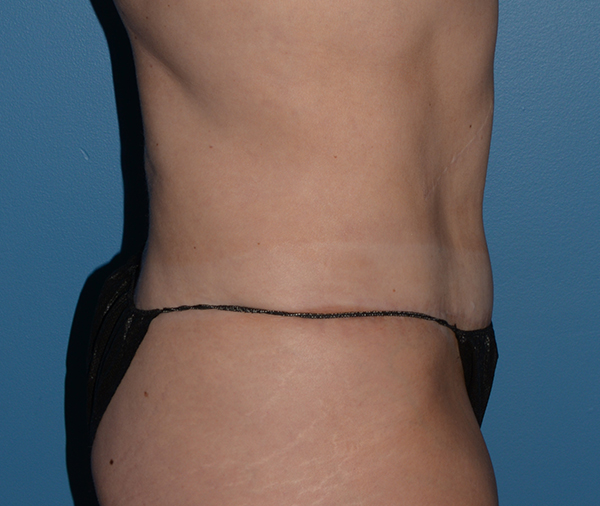 Tummy Tuck