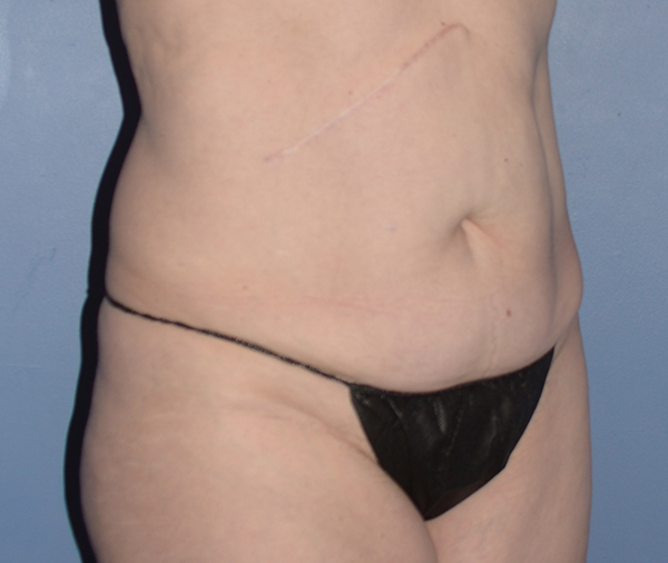 Tummy Tuck