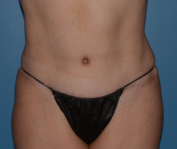 Tummy Tuck