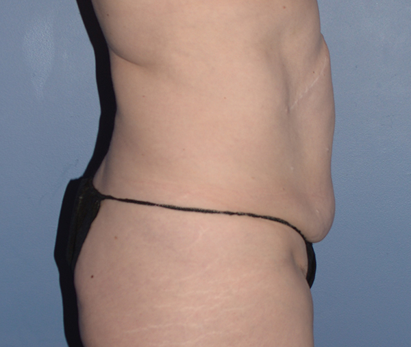 Tummy Tuck