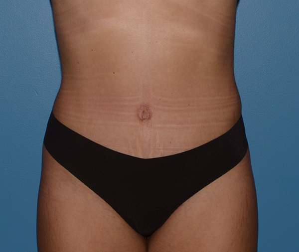 Tummy Tuck