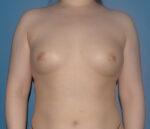 Breast Augmentation Fat