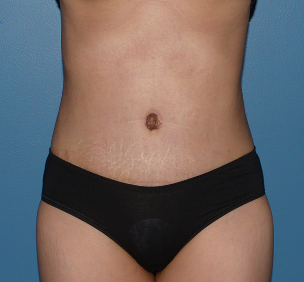 Tummy Tuck