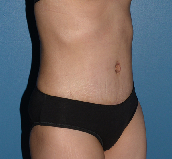 Tummy Tuck