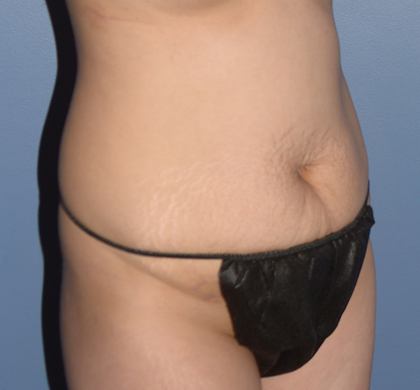 Tummy Tuck