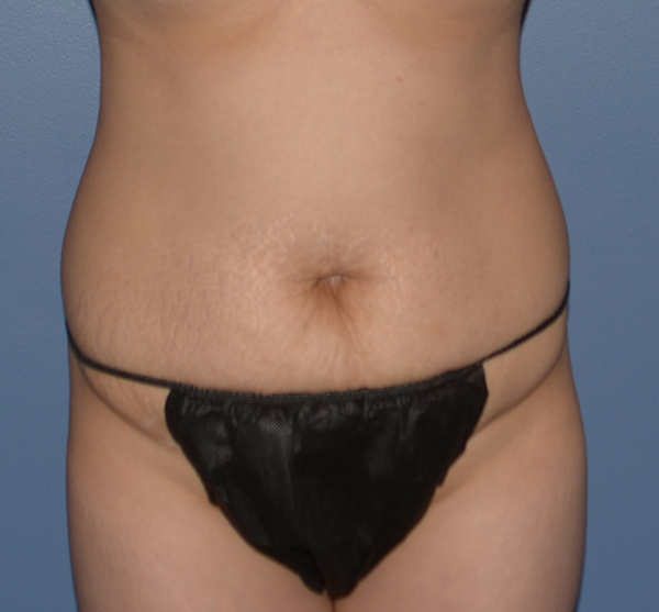 Tummy Tuck