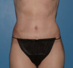 Tummy Tuck