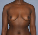 Breast Augmentation Implants