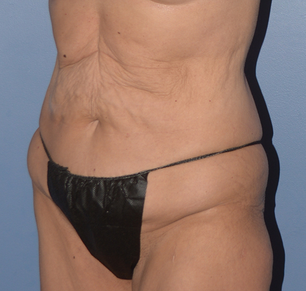 Tummy Tuck