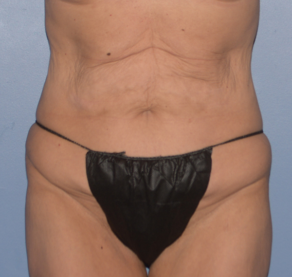 Tummy Tuck