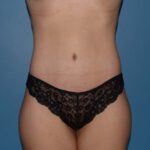 Tummy Tuck