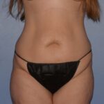 Tummy Tuck