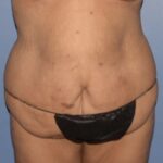 Tummy Tuck