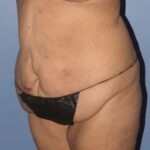 Tummy Tuck