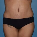 Tummy Tuck