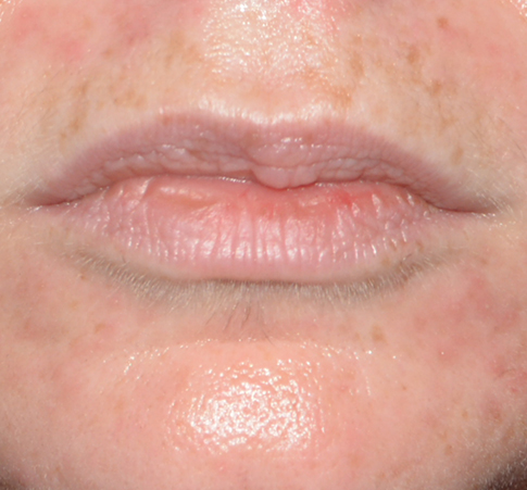 Lip Reduction