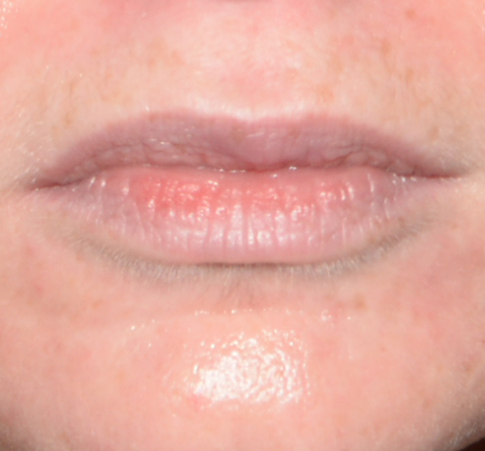 Lip Reduction