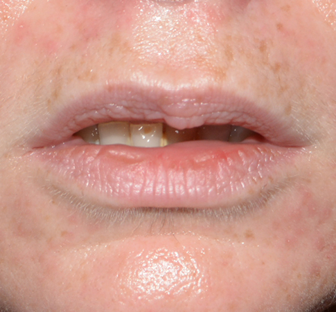 Scar or Mole Correction