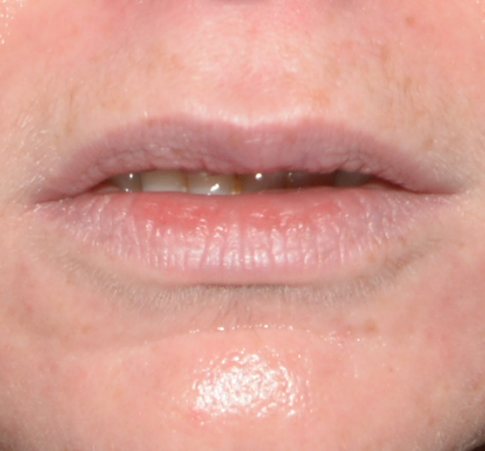 Scar or Mole Correction