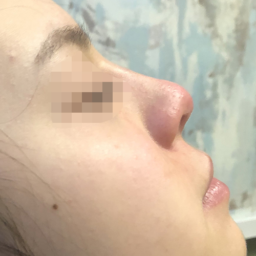 Non-Surgical Rhinoplasty