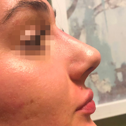 Non-Surgical Rhinoplasty