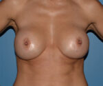 Breast Correction