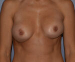 Breast Correction